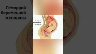 Хомладороикда геморрой  