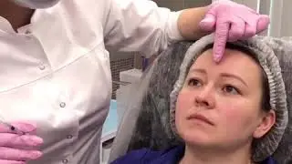Ботулинотерапия Full Face