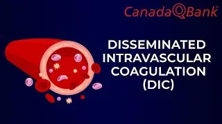 DIC (Disseminated intravascular coagulation)