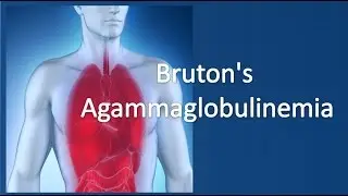 Brutons agammaglobulinemia