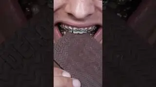 Mr. Beast Candy vs. Braces 🤯
