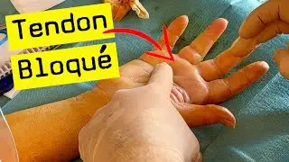 Opération d'un doigt ressaut : il libère le tendon du doigt
