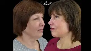 Глубокий продвинутый лифтинг лица и шеи (платизмопластика). Видео от Ильи Алмазова 