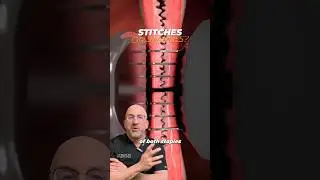 Did You Have Staples or Stitches⁉️ which is best? 