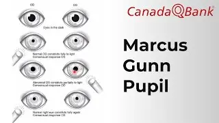 Marcus Gunn Pupil