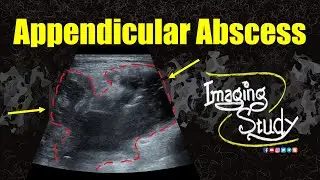 Appendicular Abscess || Ultrasound || Case 353