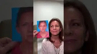 Stunning Facelift Transformation!