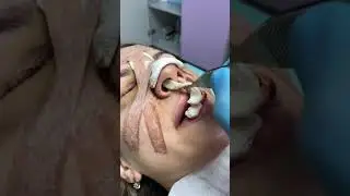 Burun Ameliyatı Sonrası Tampon Çıkarma İşlemi