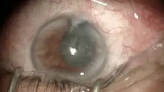 Facoextrema 2016 ::: Caso 11 - Dr. Ramiro Medina Boiko