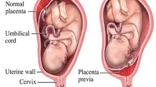 Placenta Previa