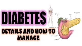 What causes Diabetes, how to manage it.