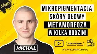 Metamorfoza w Kilka Godzin - Przemiana po Mikropigmentacji Skóry Głowy! KLINIKA SMP