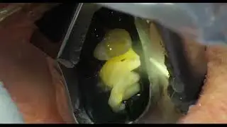 Time-lapse of first fully automated dental procedure