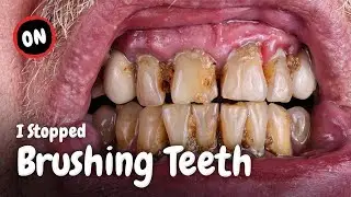 What Happens When You Stop Brushing Your Teeth?