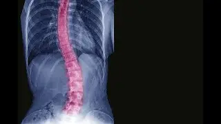 Adult Degenerative Scoliosis: Causes, Symptoms, and Treatments