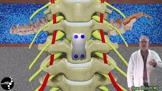 Anterior Cervical Decompression and Fusion