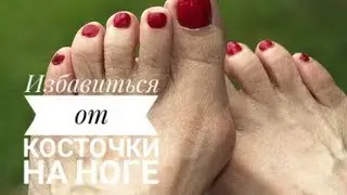 Избавиться от косточки на ноге.