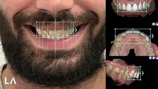 Smile Creator and Digital Wax-up in EXOCAD