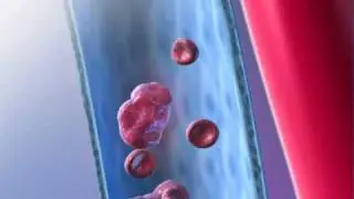 Pulmonary Embolism