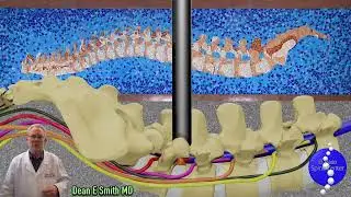 What is a MicroDiscectomy?