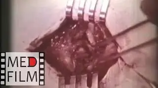 Surgical treatment of the cranial vault traumas