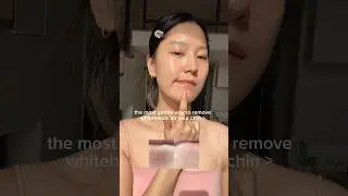 the most gentle way to remove whiteheads on your chin 