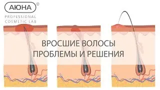 ВРОСШИЕ ВОЛОСЫ, проблемы и решения. Шугаринг и дерматология. Псевдофолликулит, гиперкератоз, рубцы.