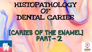 HISTOPATHOLOGY OF DENTAL CARIES - CARIES IN THE ENAMEL PART-2