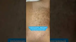 Избавляемся от вросших волос🔥 