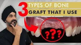 3 Types of Dental Bone Grafts That I Use Routinely