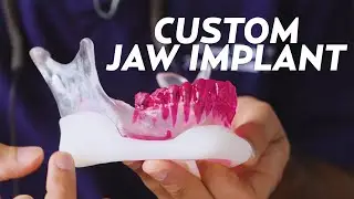 A Custom Jaw Implant Surgery for Matthew | PLASTIC with Dr. Dhir