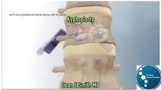 Should I have Surgery On My Lumbar Compression Fracture?