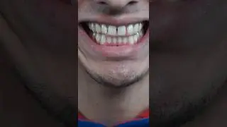 My Full Braces Journey… so far 😁