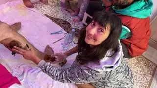 Хирудотерапия за Разширени Вени на Крака. Лечение пиявками, Гирудотерапия варикозного расширения вен