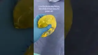 Why Are These 18 Year Old Breast Implants Slightly Yellow? #shorts #breastimplants