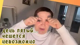 ДЕНЬ ПЯТЫЙ! БЛЕФАРОПЛАСТИКА ХОЛОДНАЯ ПЛАЗМА! 