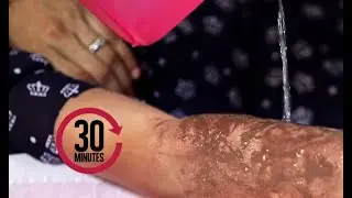 First aid for acid burns (general body injuries)