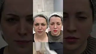 Результаты после ботокса, которые вам понравятся! 
