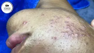 Removing blackheads and whiteheads from the face - Very Satisfactory Video