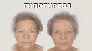 Гипотиреоз Гипофункция щитовидной железы Симптомы гипотиреоза