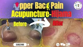 Wet Cupping (Hijama)-Acupuncture for Upper Back Pain | Whole Session Video | How are they performed?
