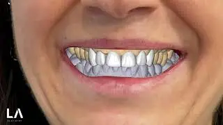 Smile Creator and Digital Wax-up in EXOCAD Case 2