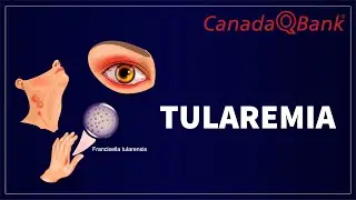 Tularemia