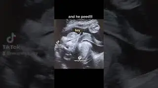Baby boy peed in womb