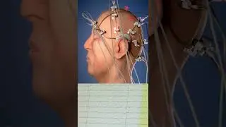 Brain Electrical Activity 🤯EEG ° ElectroEncephaloGram
