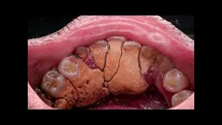 UNBELIEVABLY GIGANTIC TARTAR  Removal by Dentist