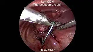 Demonstration of thoracoscopic repair of left side CDH without sac by Dr. Rasik Shah in a newborn.
