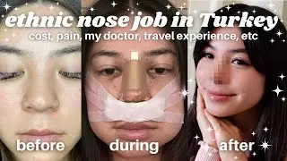 I GOT A NOSE JOB IN TURKEY // asian ethnic rhinoplasty with Dr. Alpaslan Yildirim (@estetik_burun) ✿