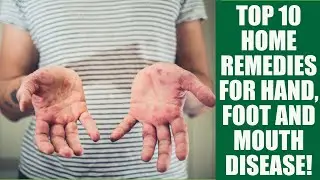 10 Highly Effective Home Remedies for Hand Foot and Mouth Disease