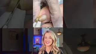 Doctor reacts: extreme ingrown nail removal